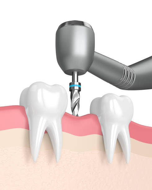 Alternative Treatments For Root Canal Discovery Body