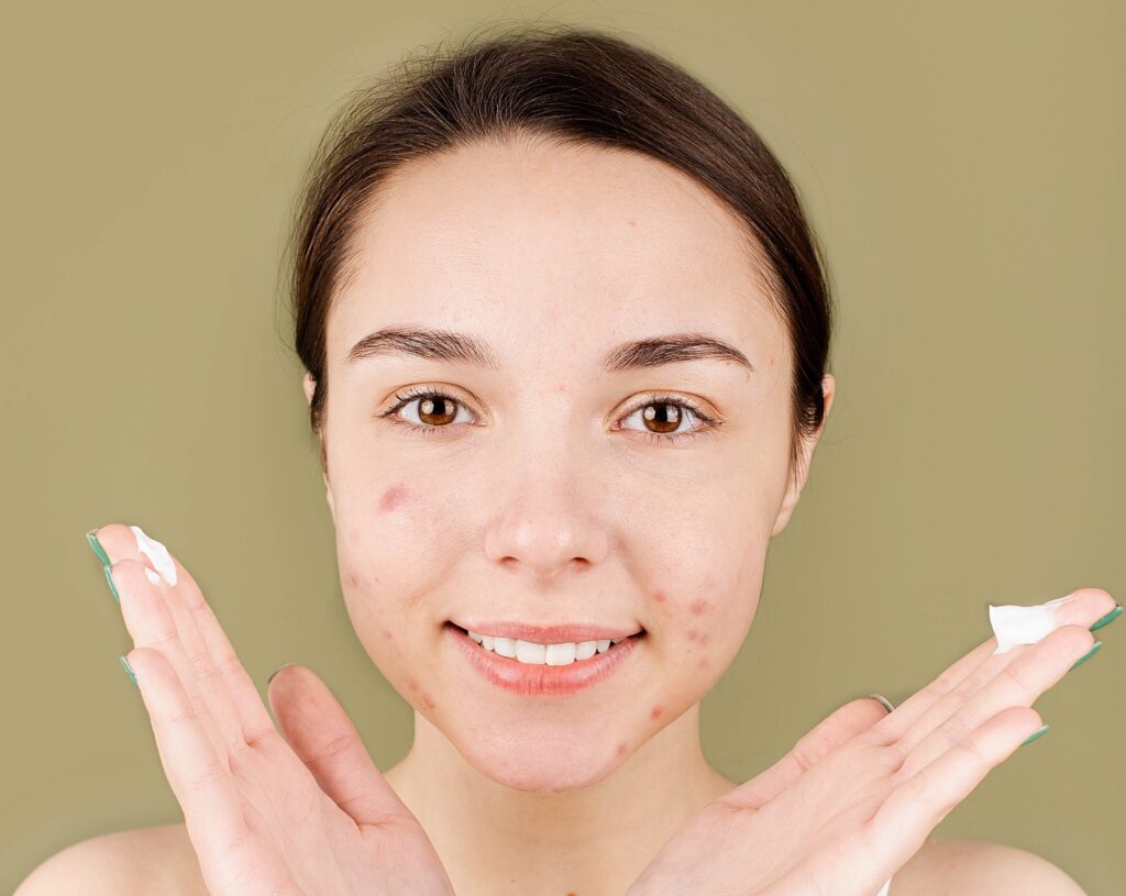 Acne Skin condition