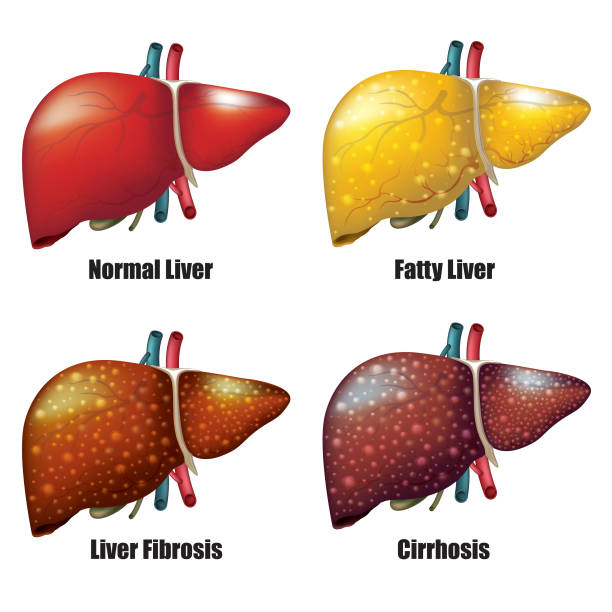 Understanding the ABCs of Fatty Liver Disease - Discovery Body