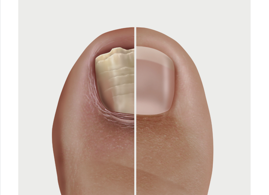 fungal nail infections