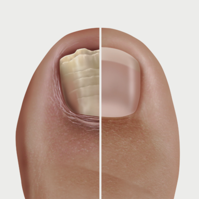 fungal nail infections