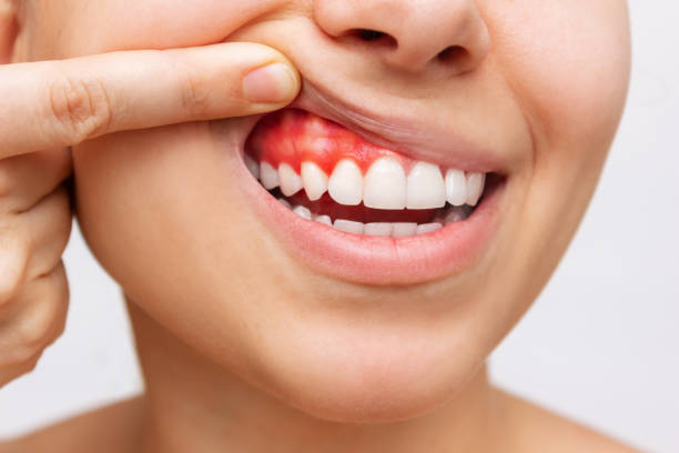 inflammation on the gums