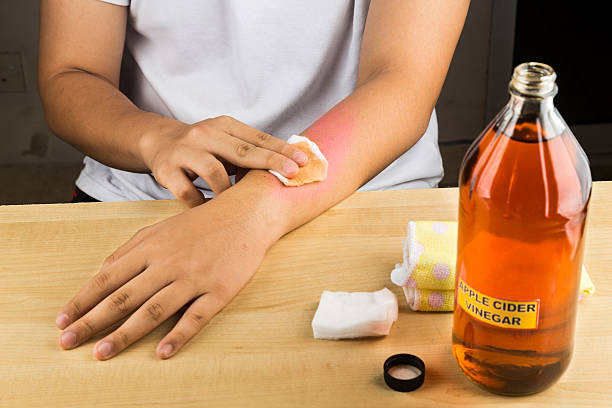 Claims and Evidence of Apple Cider Vinegar's Effectiveness on Warts