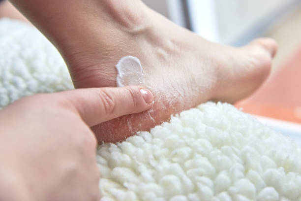 OTC fungus treatments