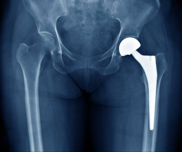 Joint replaced