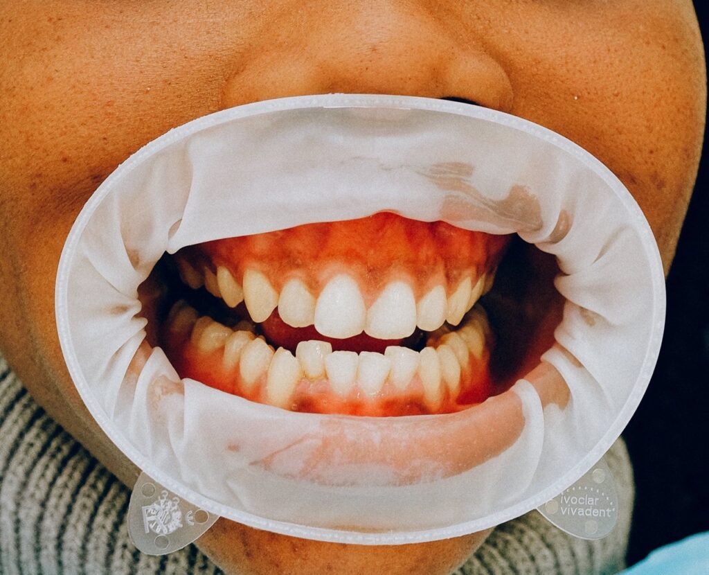What Does Teeth Whitening Do To Cavities?
