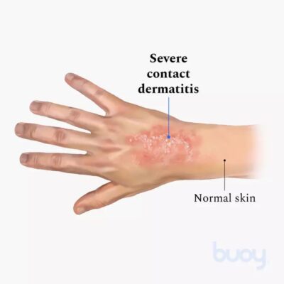 How To Prevent And Lessen Contact Dermatitis