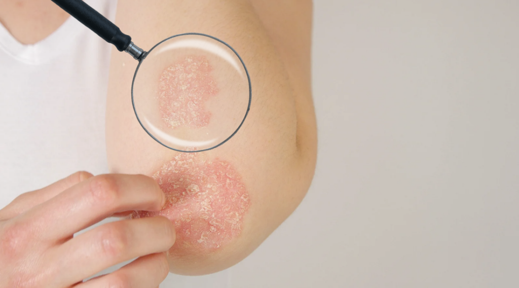 Atopic Dermatitis or eczema