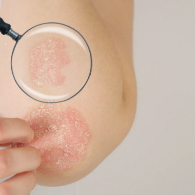 Atopic Dermatitis or eczema
