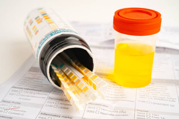 Abnormal Urine Colors and Health Implications