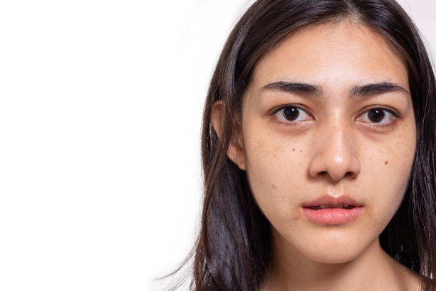 The Benefits of Using Herbs for Dark Circle Treatment