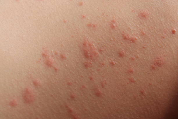 Common Causes of Contact Dermatitis