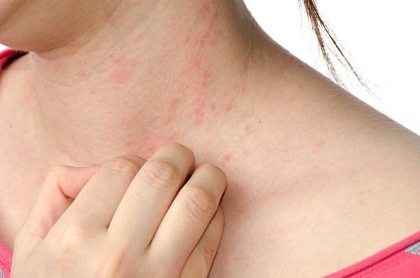 Diagnosis and Treatment Options for Contact Dermatitis