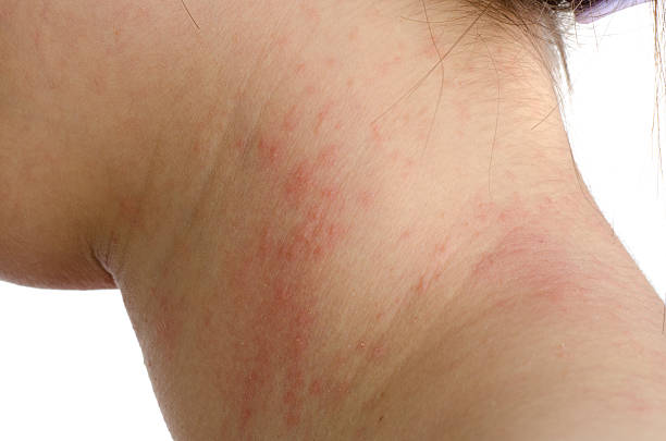 Natural Remedies for Contact Dermatitis