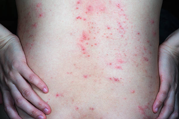 Contact Dermatitis and Occupational Hazards
