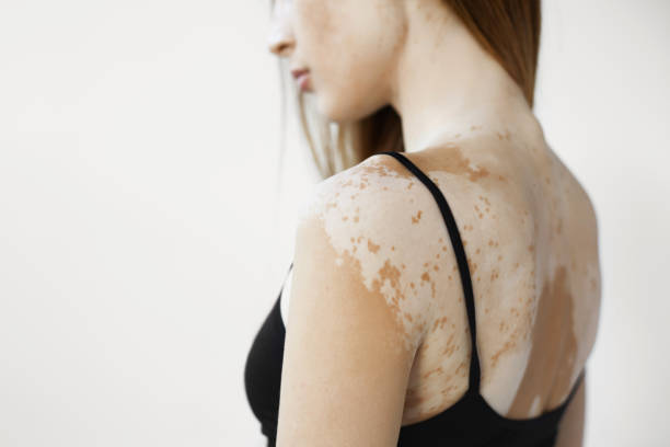 Potential Side Effects and Precautions of Collagen Supplements for Vitiligo
