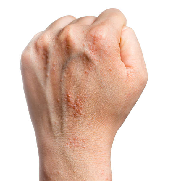 Common Symptoms of Contact Dermatitis