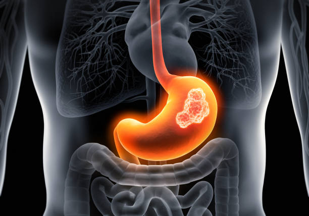 Medical Conditions Associated with Bloating