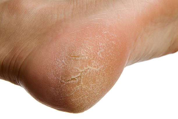 Common Foot Problems and How Essential Oils Can Help