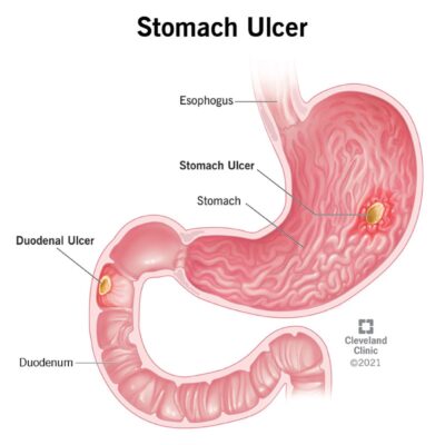 Discover the Treatment for Stomach Ulcers