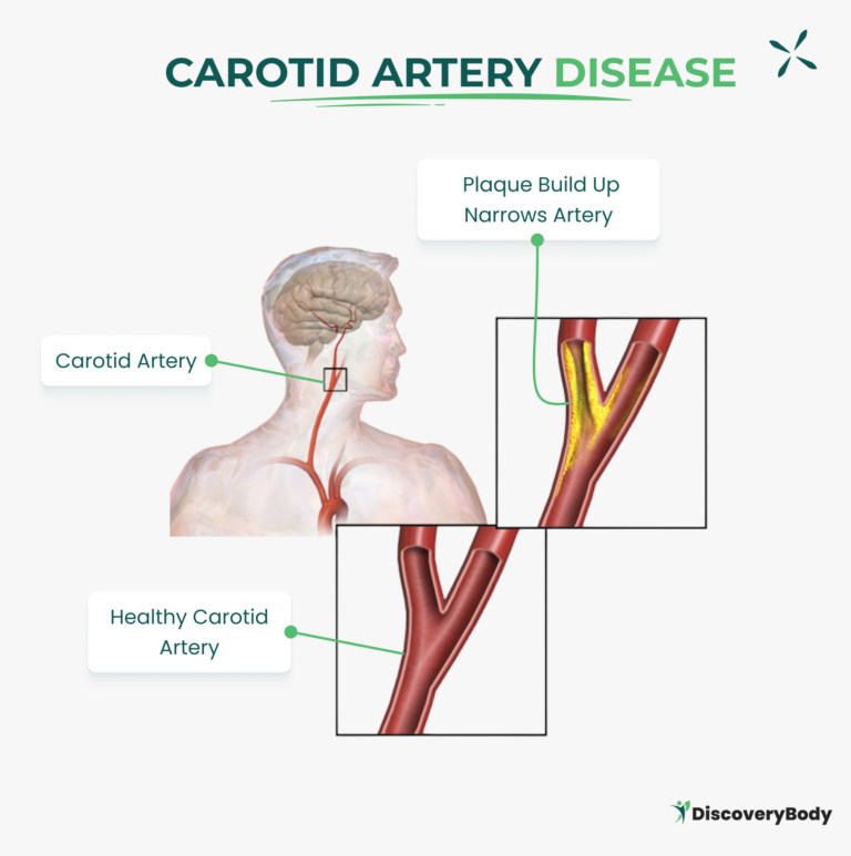 What are the Symptoms of Blocked Arteries in Your Neck: Recognizing the ...