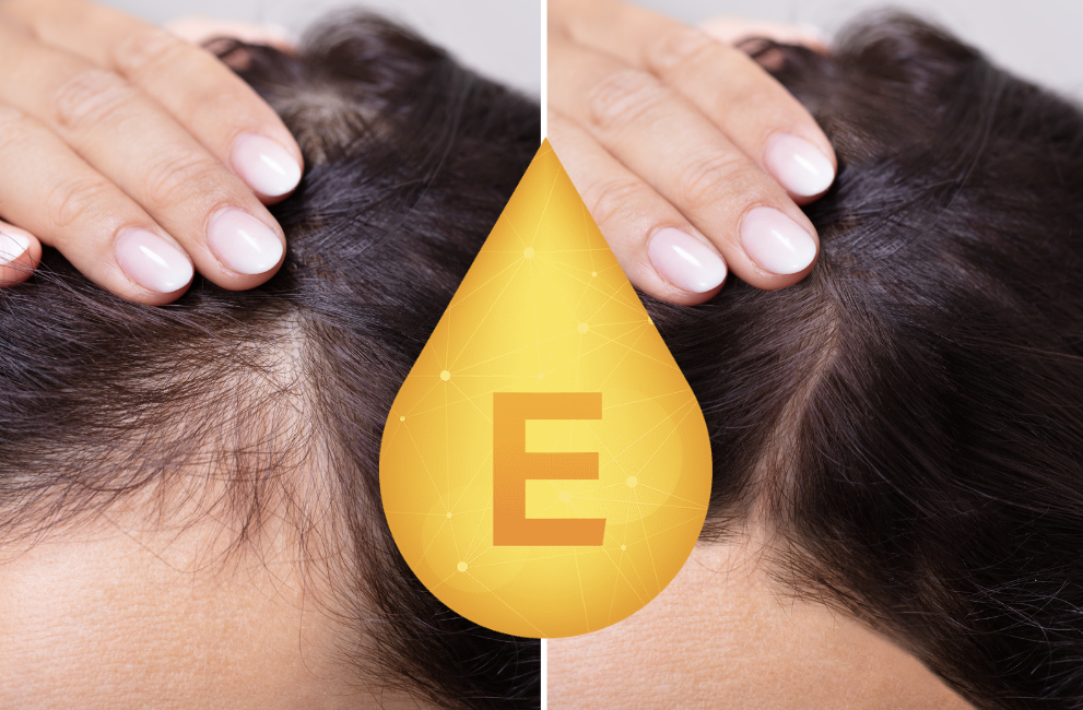 Is Vitamin E Good For Preventing Hair Loss