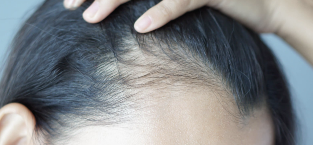 supplements that cause hair thinning