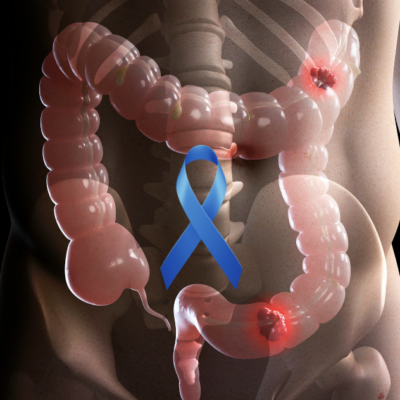 steps to take if you have colon cancer