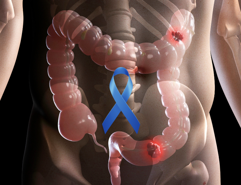 steps to take if you have colon cancer