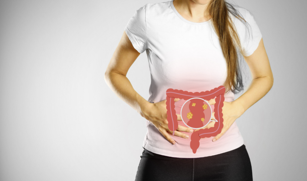 colon cancer in women