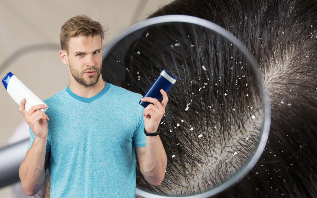 Are Chemical-Based Dandruff Treatments Ruining Your Hair?