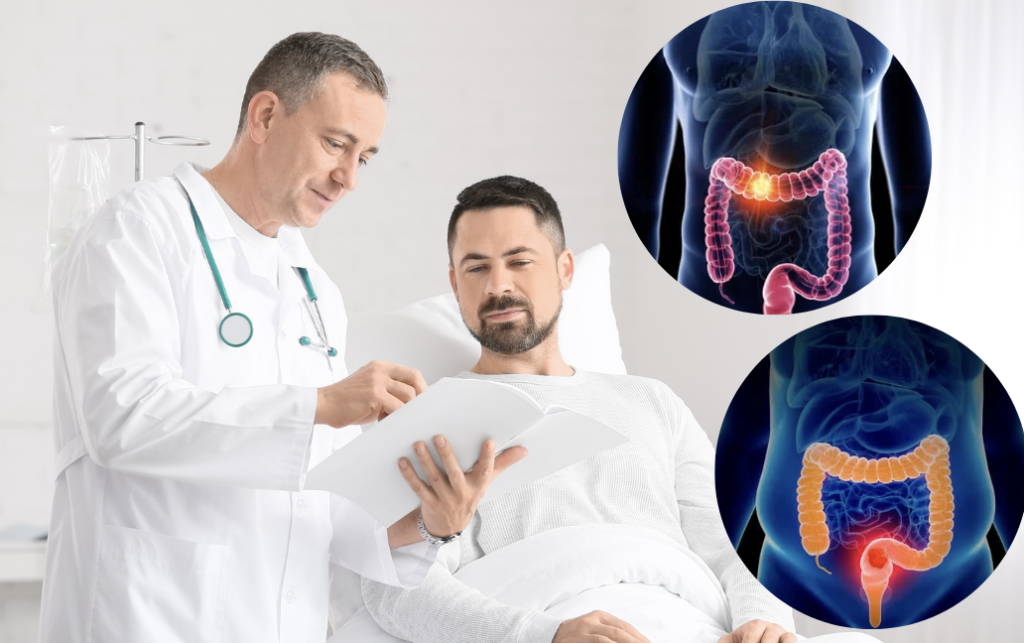 Recognizing the Stages and Symptoms of Colon Cancer