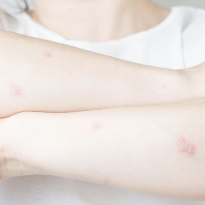 Take Control of Psoriasis and Uncover the Most Common Causes