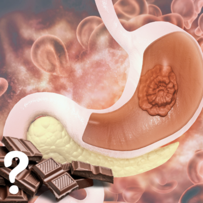 Is Chocolate Really Bad for Stomach Ulcers?