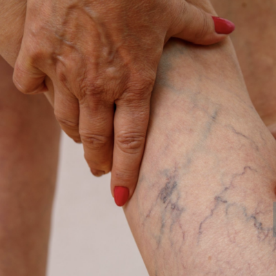 Homeopathic Medicine and its Benefits for Varicose Veins