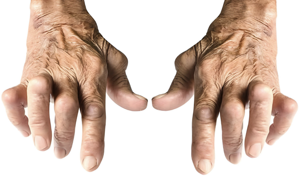 What is Rheumatoid Arthritis Disease
