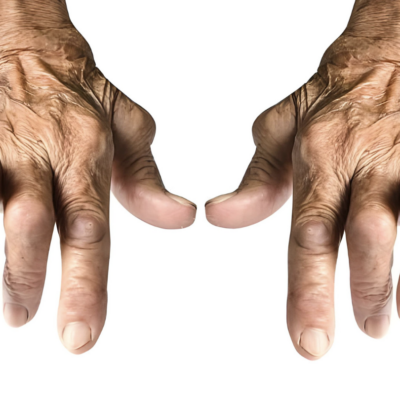 What is Rheumatoid Arthritis Disease
