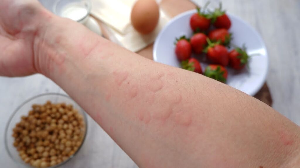 Long-Term Consequences of Ignoring Your Food Allergies