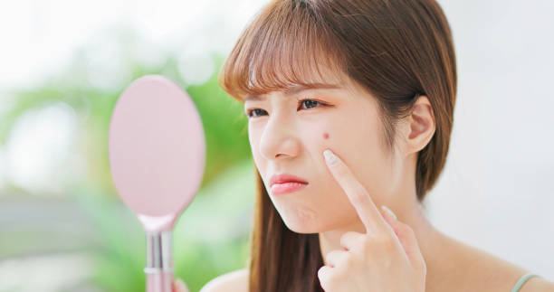 Korean Skincare for Acne-Prone Skin