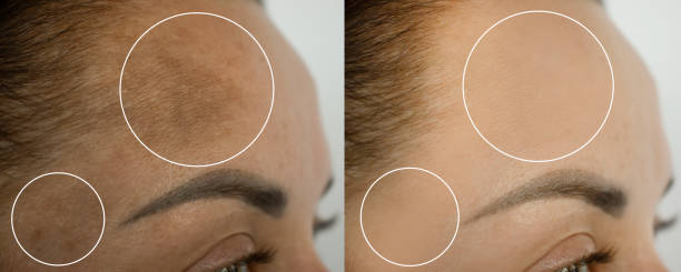 Skin pigmentation refers to the hue of one's skin.