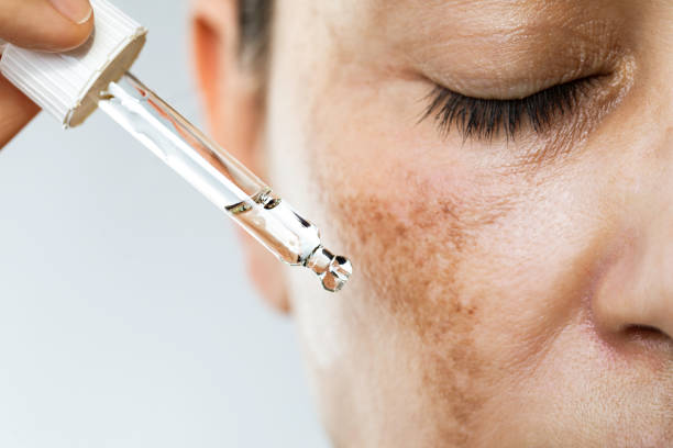 While these pigmentationcreams might help reduce the appearance of hyperpigmentation, they can also cause skin irritation if not used correctly.
