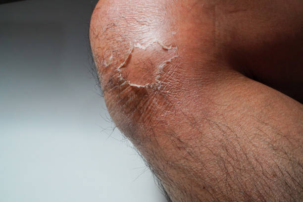 Tips for Preventing Dry, Itchy Skin in the Elderly