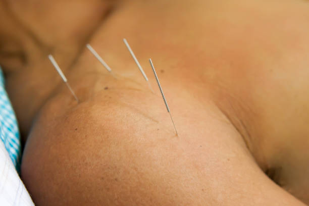 What to Expect During an Acupuncture Session for Frozen Shoulder