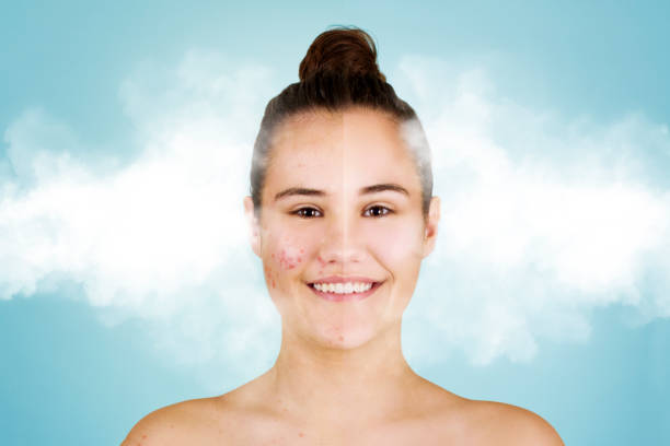 Effects of Smoking on Acne and Other Skin Conditions