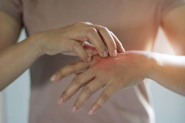 Common Types of Skin Fungal Infections