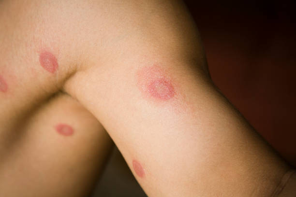 If you already have a skin fungal infection, prompt treatment is essential to prevent it from spreading and worsening.
