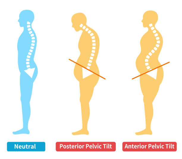 Exercises to Correct Anterior Pelvic Tilt
