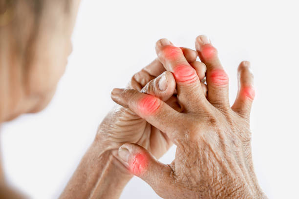 Understanding Arthritis in Fingers