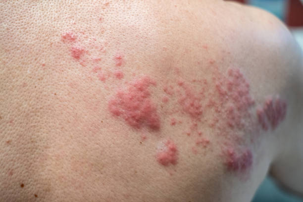 Understanding Contagious Skin Rashes - Discovery Body