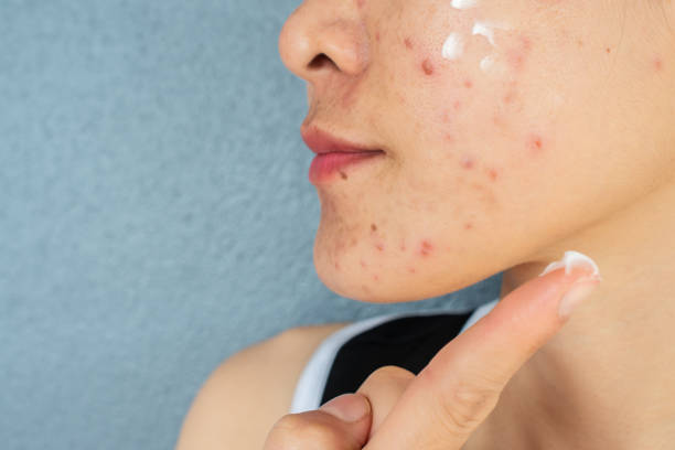 Diet plays an important role in naturopathic acne treatment. 